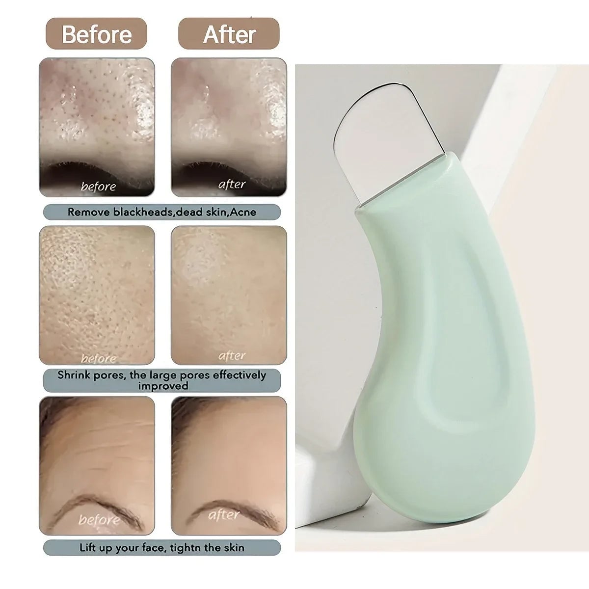 Blackhead Whitehead Removal Tool - Professional Pore Cleaner Kit